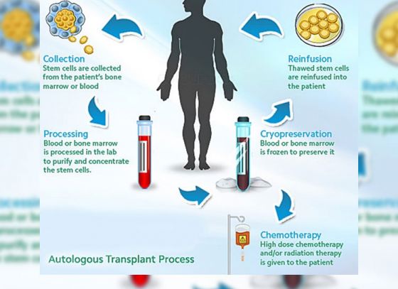 Autologous stem cell therapy may hold key to regeneration.