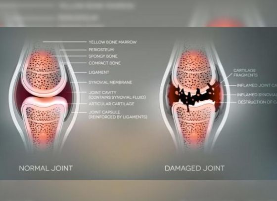 5 Ways to Get Rid of Rheumatoid Arthritis