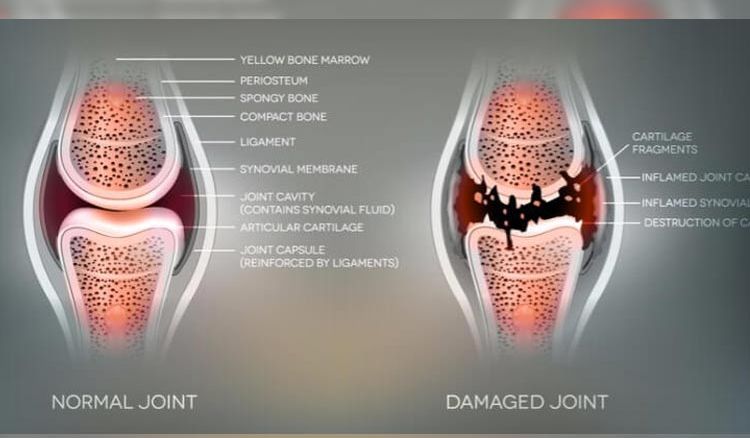 5 Ways to Get Rid of Rheumatoid Arthritis