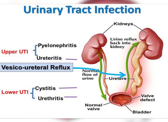 5 Common Causes of Urinary Tract Infection