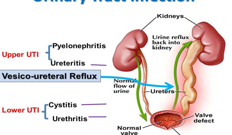 5CommonCausesofUrinaryTractInfection