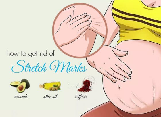 How to get rid of stretch marks?