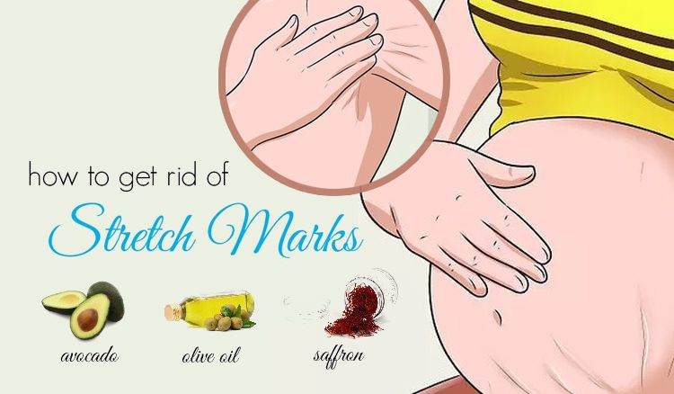 How to get rid of stretch marks?