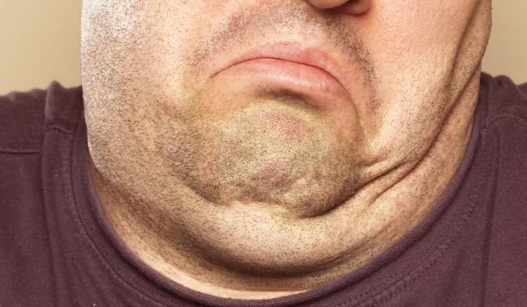 Solution of double chin