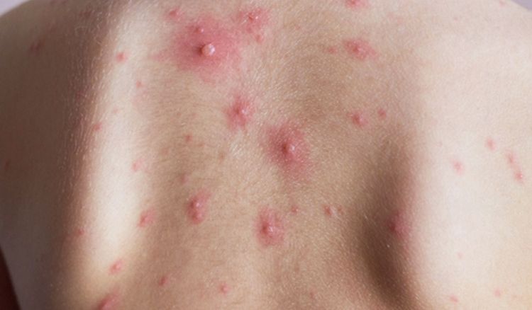 Home remedy of chicken pox