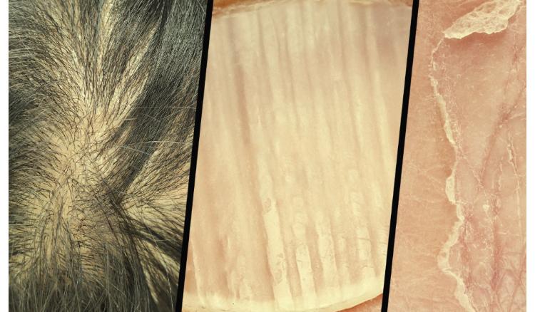 Primary signs and symptoms of protein deficiency