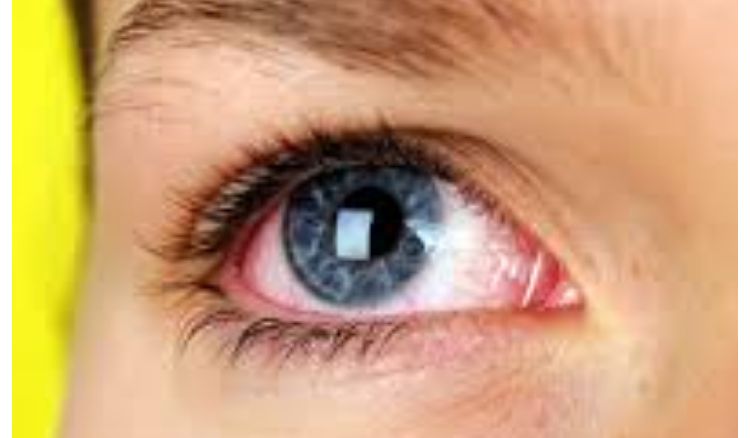 Dryness of eyes