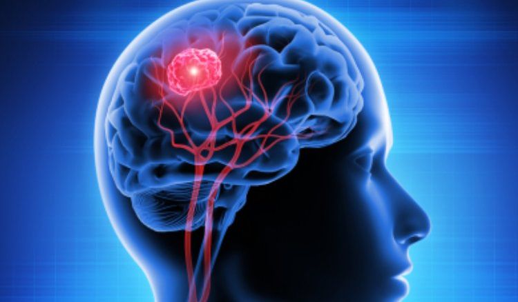 What Is Astrocytoma?