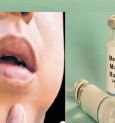 Mumps Outbreak In Kerala Raises Concerns! What Are The symptoms Of This Disease?