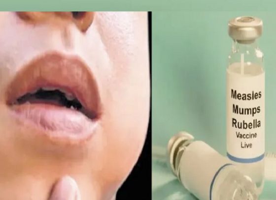 Mumps Outbreak In Kerala Raises Concerns! What Are The symptoms Of This Disease?