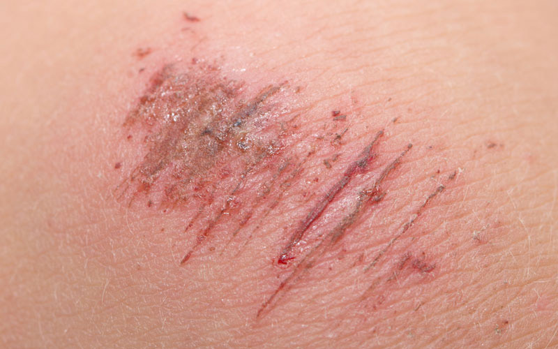 wounds